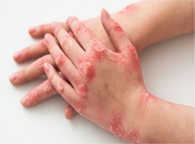 psoriasis 1