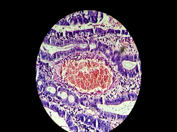 tumor colon